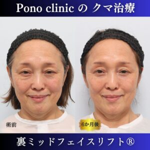 目の下のクマ、目の下のたるみ、裏ハムラ、骨膜下リフト、裏ミッドフェイスリフト、60代の症例 (4)