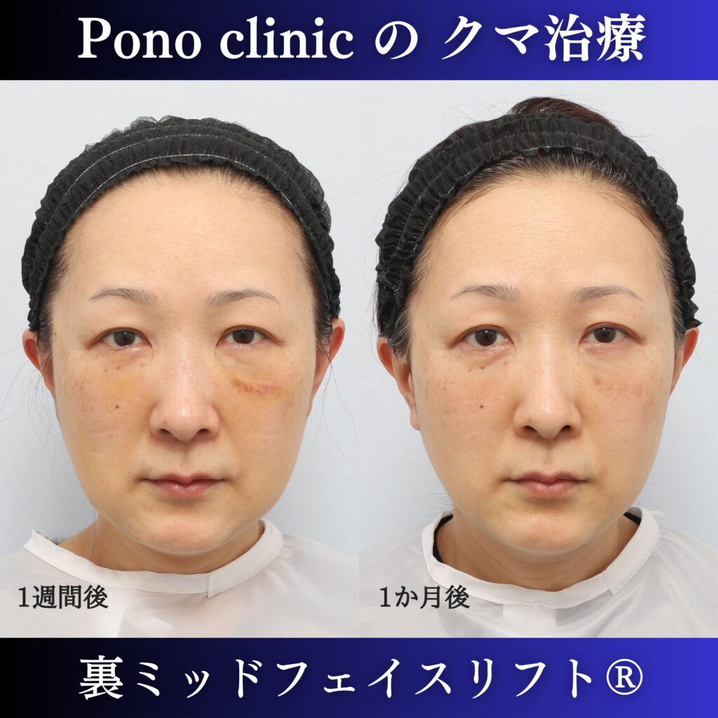 50代女性の裏ミッドフェイスリフト術後1週間と術後1か月の経過比較