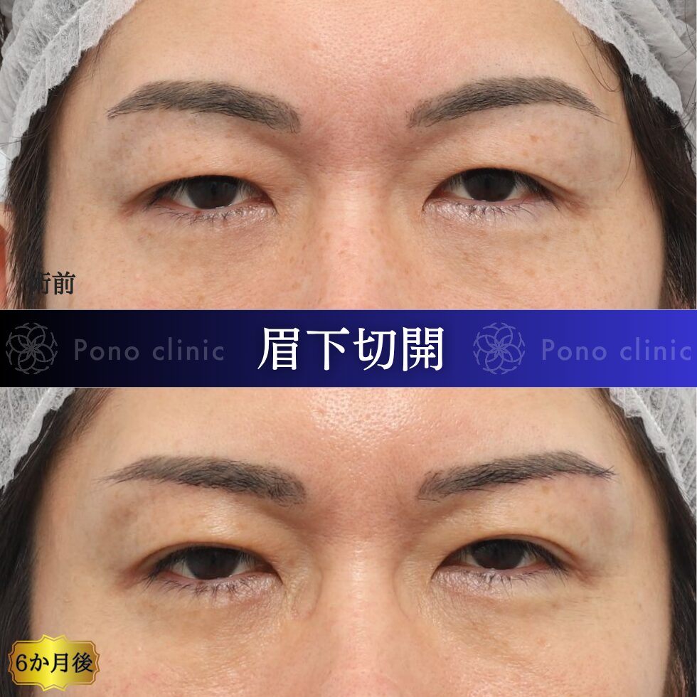 眉下切開、眉下リフト、目の上のたるみ、40代男性 (4)