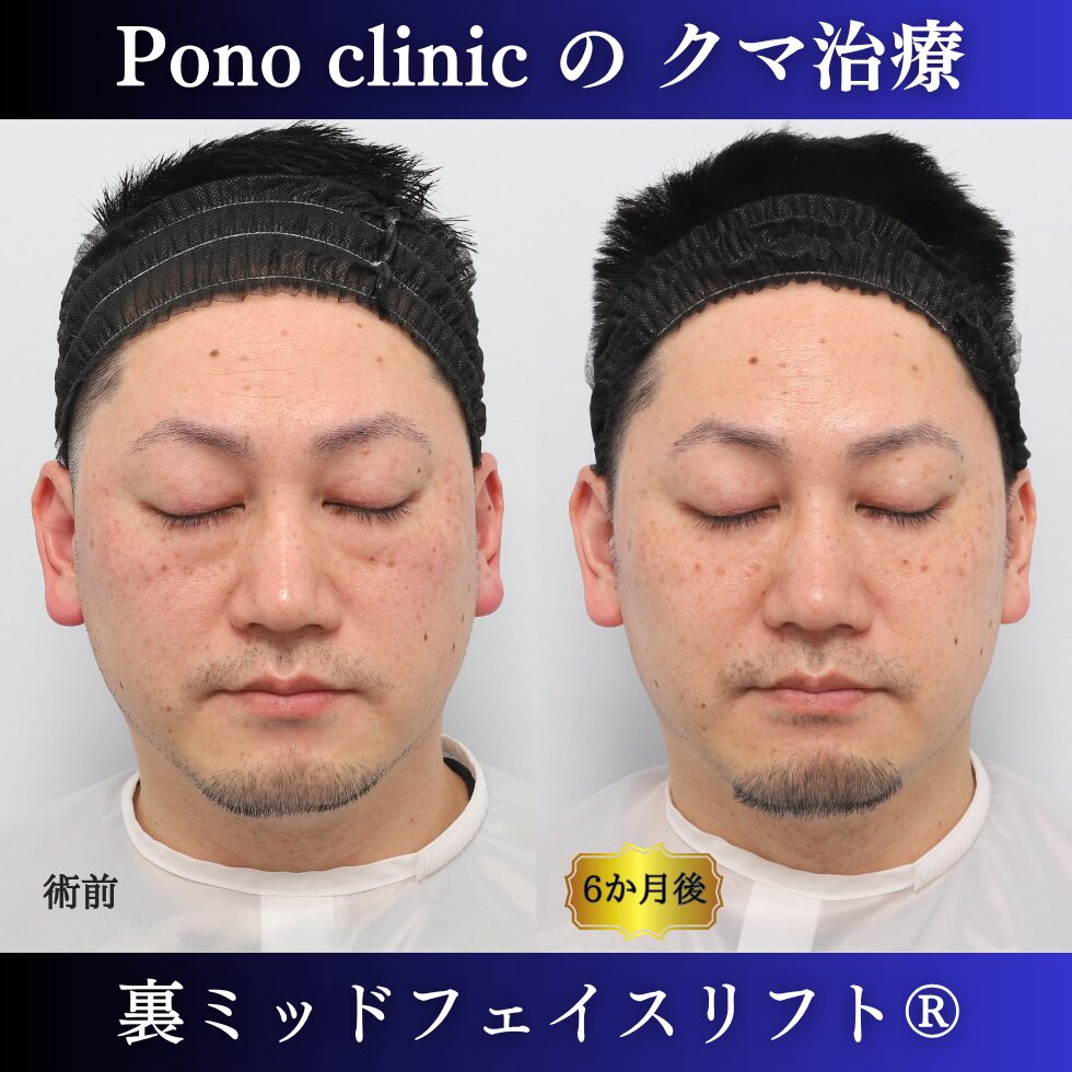 40代男性の裏ミッドフェイスリフト術前・術後の閉眼時比較