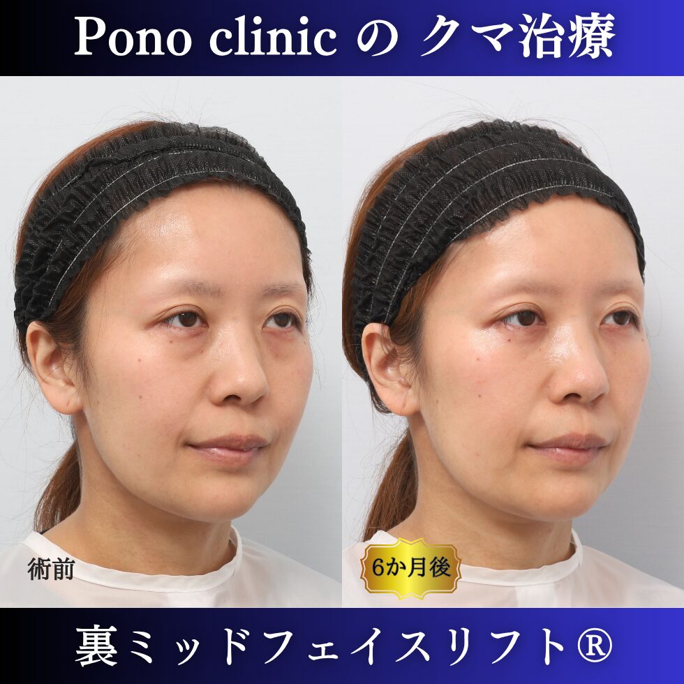 30代女性の裏ミッドフェイスリフト術前・術後の右斜位比較