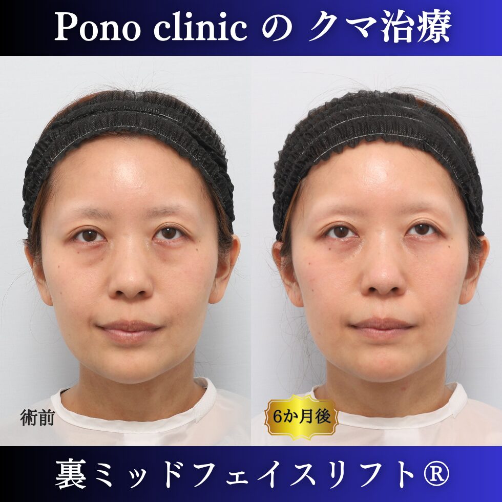 30代女性の裏ミッドフェイスリフト術前・術後の上方視比較