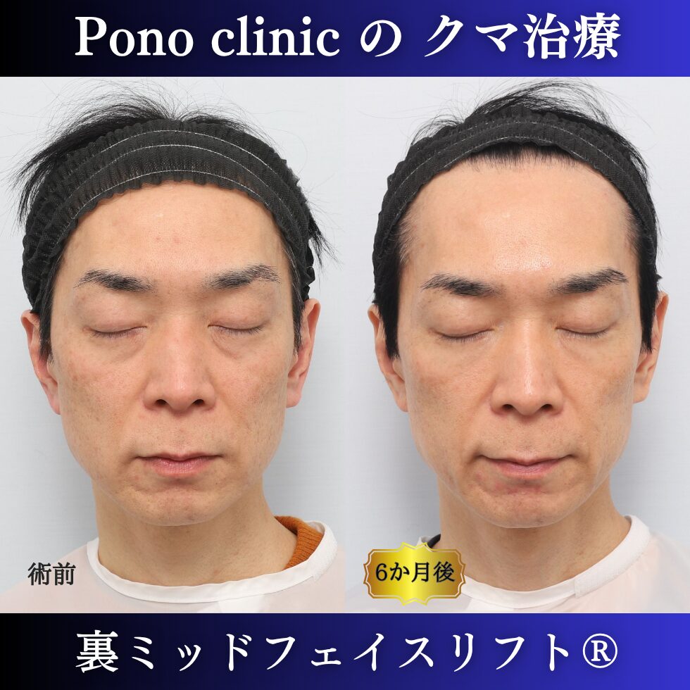 40代男性の裏ミッドフェイスリフト術前と術後6か月の閉眼比較