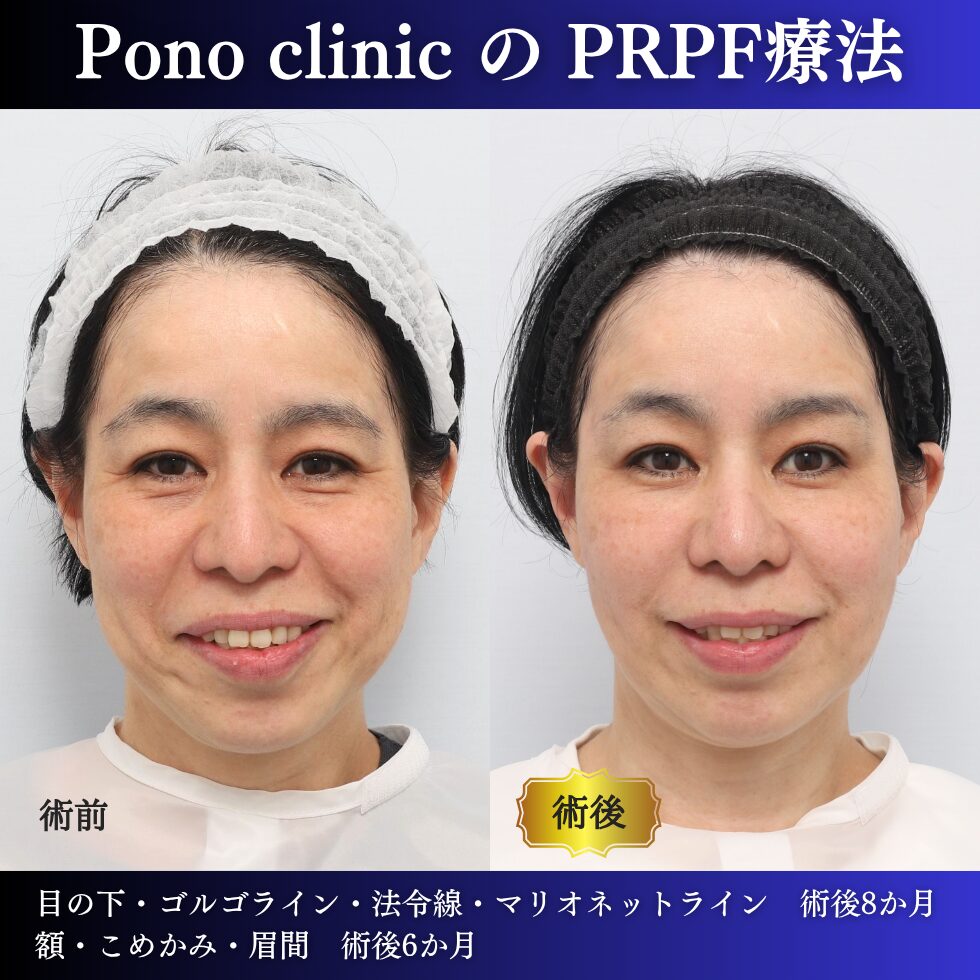 50代女性のPRPF®療法笑顔・ほうれい線と鼻翼基部を含む治療前治療後比較