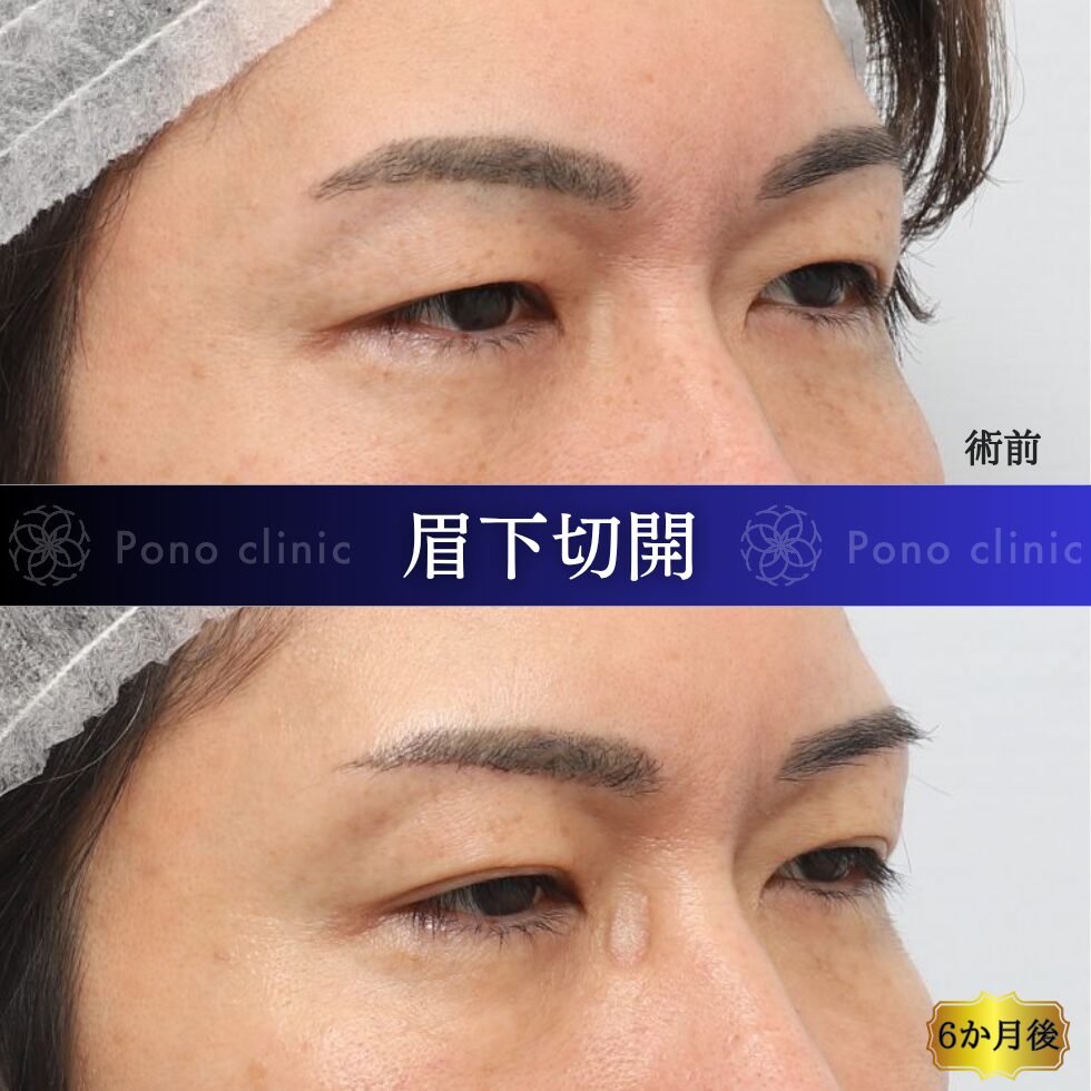 眉下切開、眉下リフト、目の上のたるみ、40代男性 (1)