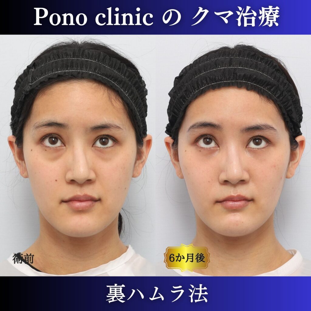 20代女性の裏ハムラ上方視・術前術後比較