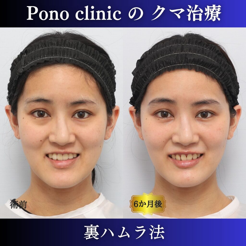 20代女性の裏ハムラ笑顔・術前術後比較