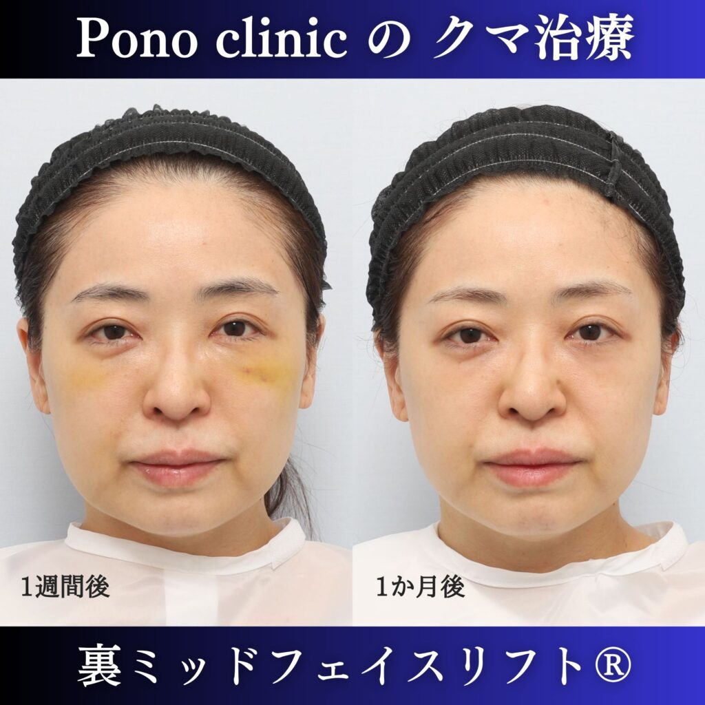 40代女性の裏ミッドフェイスリフト術後1週間・術後1か月の経過比較