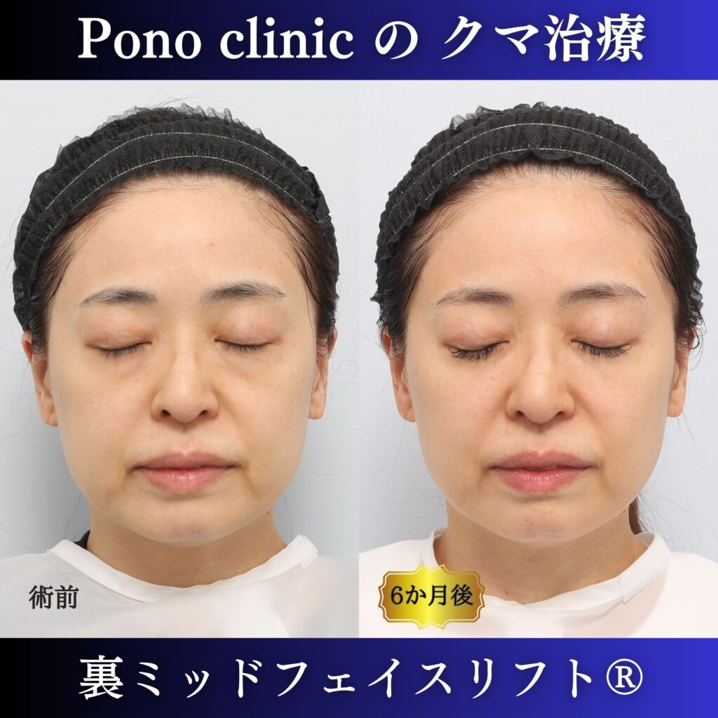 40代女性の裏ミッドフェイスリフト術前・術後6か月の閉眼時比較