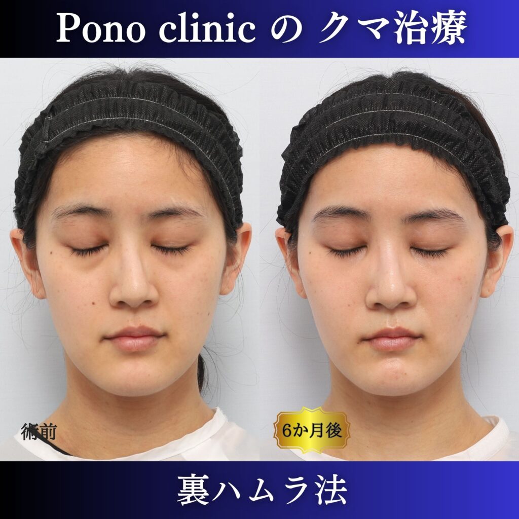 20代女性の裏ハムラ閉眼・術前術後比較