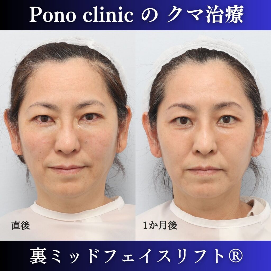 50代女性の裏ミッドフェイスリフト術直後・術後1か月の経過比較