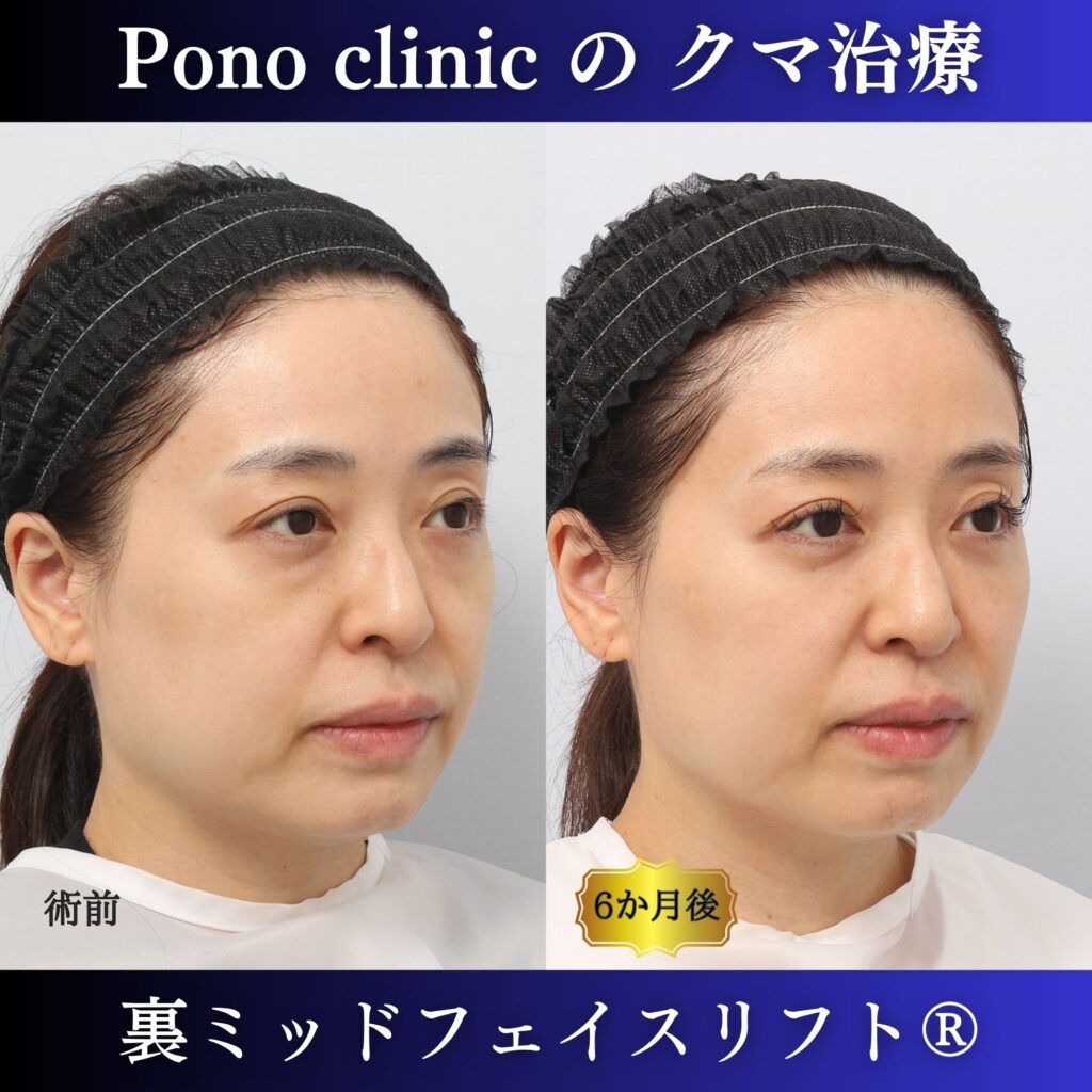 40代女性の裏ミッドフェイスリフト術前・術後6か月の右斜位比較