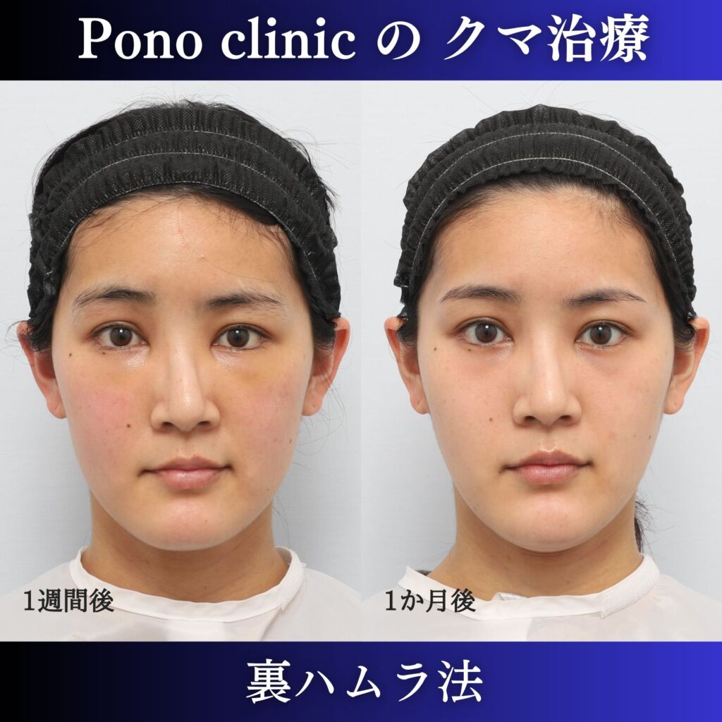 20代女性の裏ハムラ術後1週間と1か月の経過