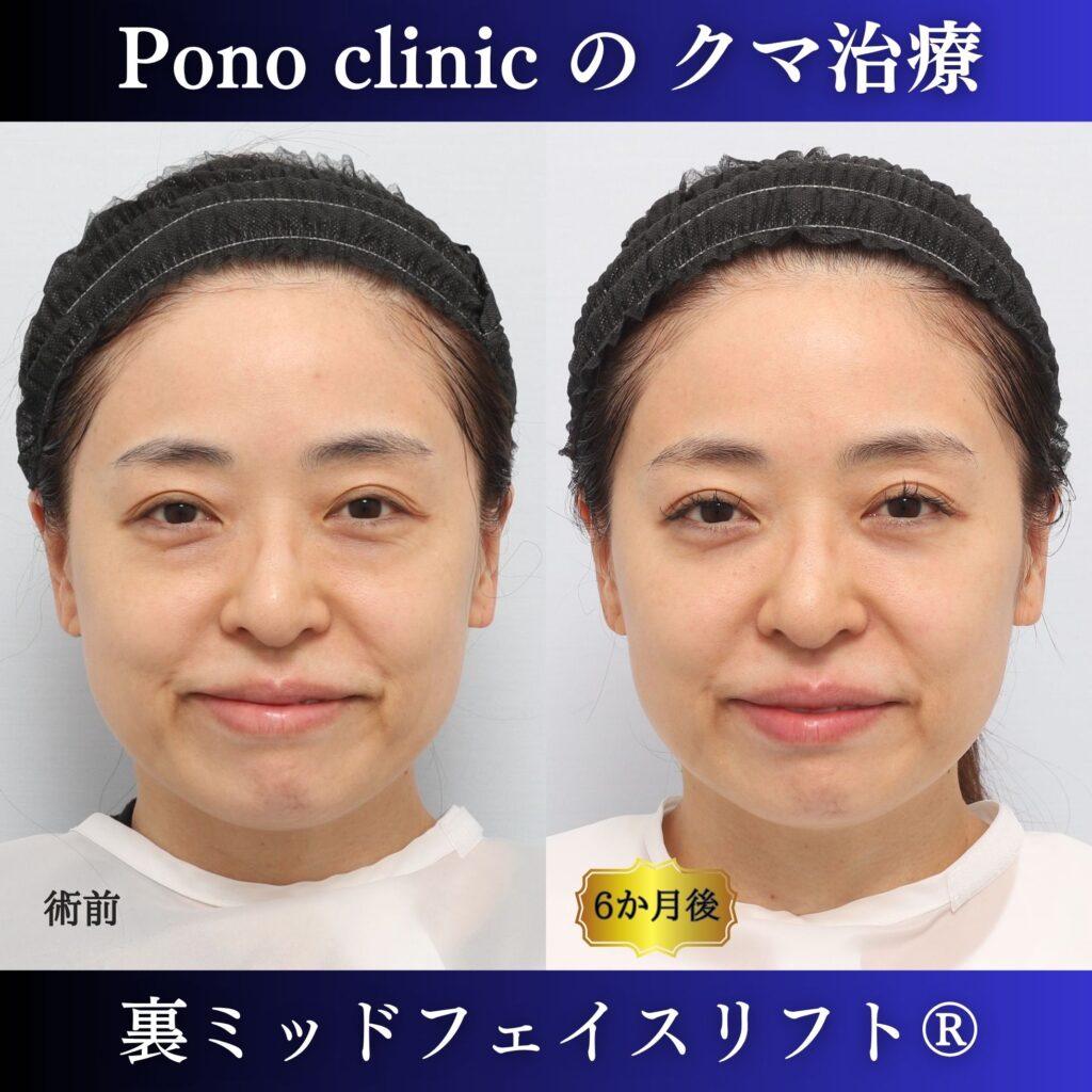40代女性の裏ミッドフェイスリフト術前・術後6か月の笑顔比較