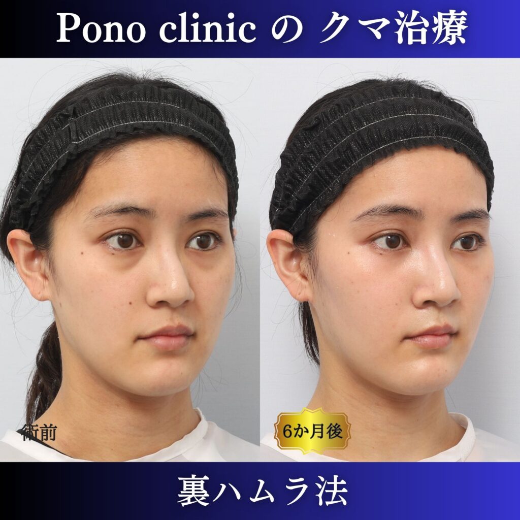 20代女性の裏ハムラ右斜位・術前術後比較