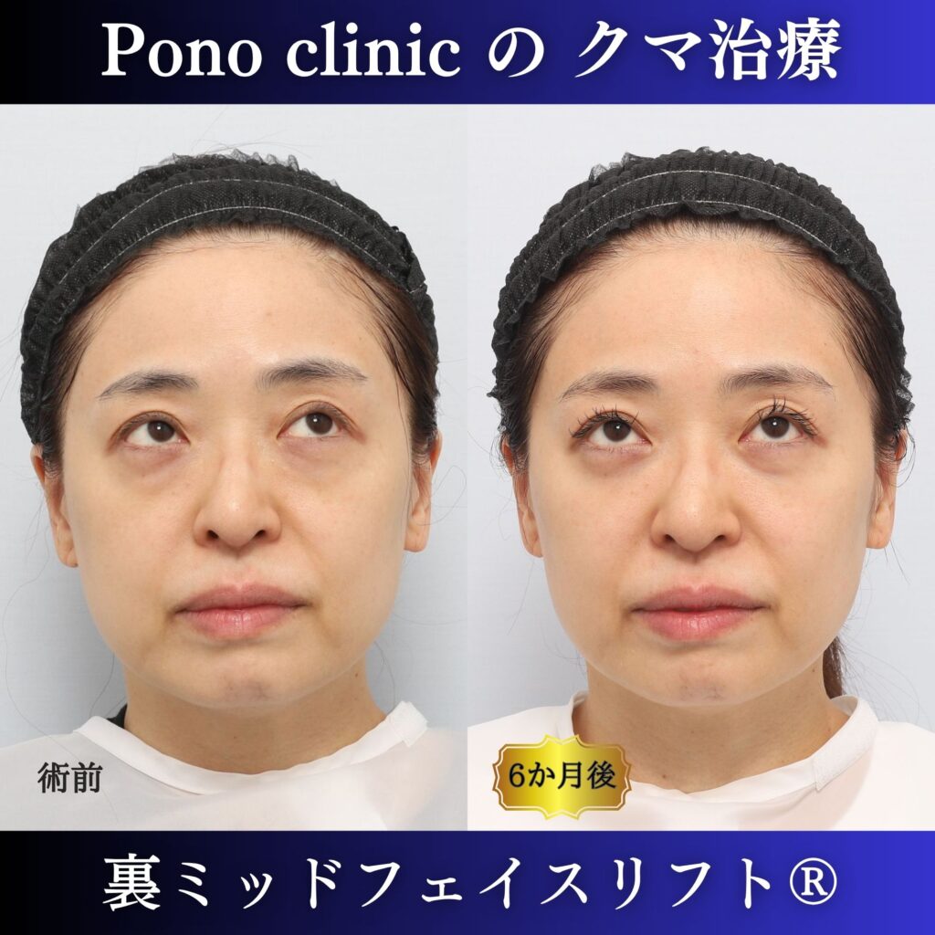40代女性の裏ミッドフェイスリフト術前・術後6か月の上方視比較