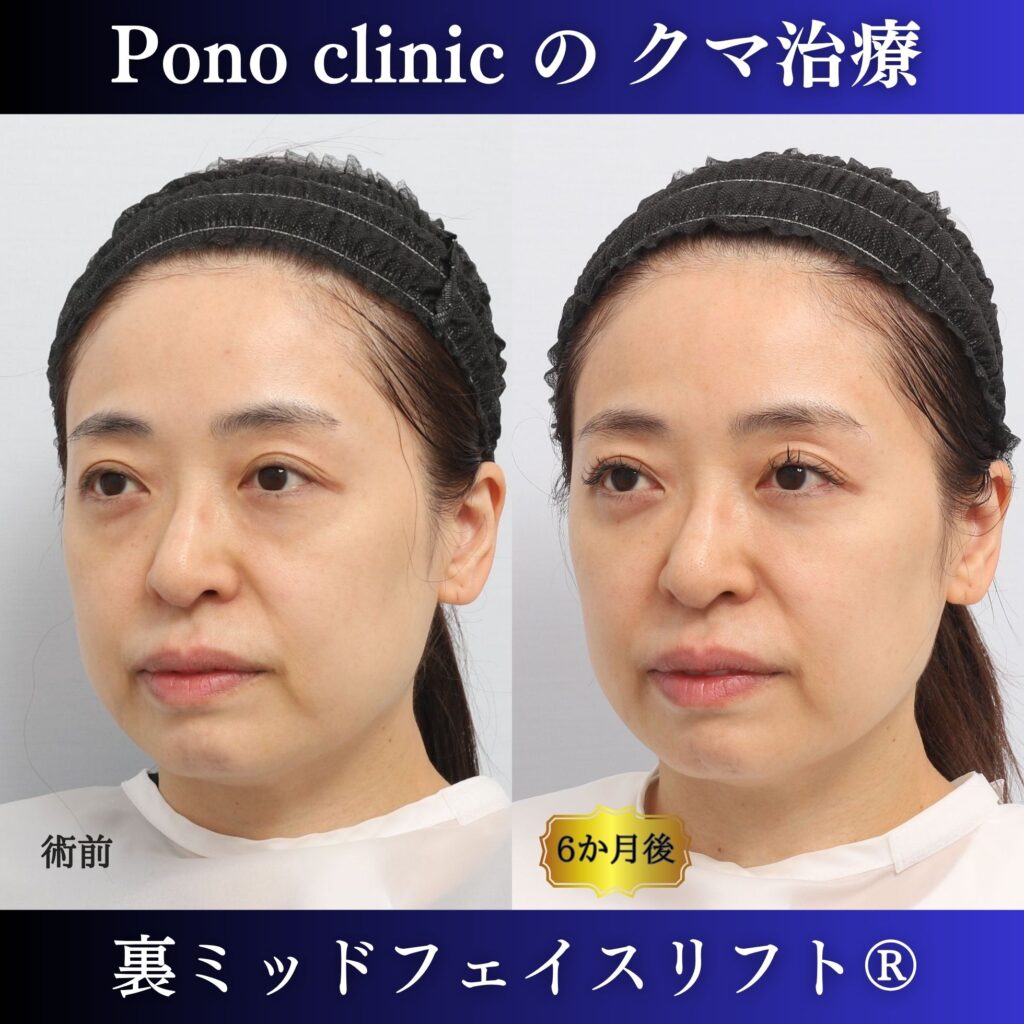 40代女性の裏ミッドフェイスリフト術前・術後6か月の左斜位比較
