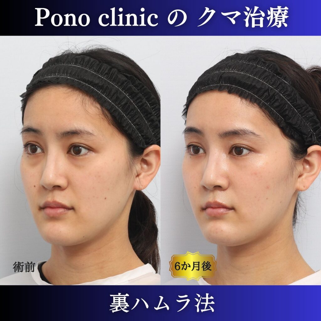 20代女性の裏ハムラ左斜位・術前術後比較