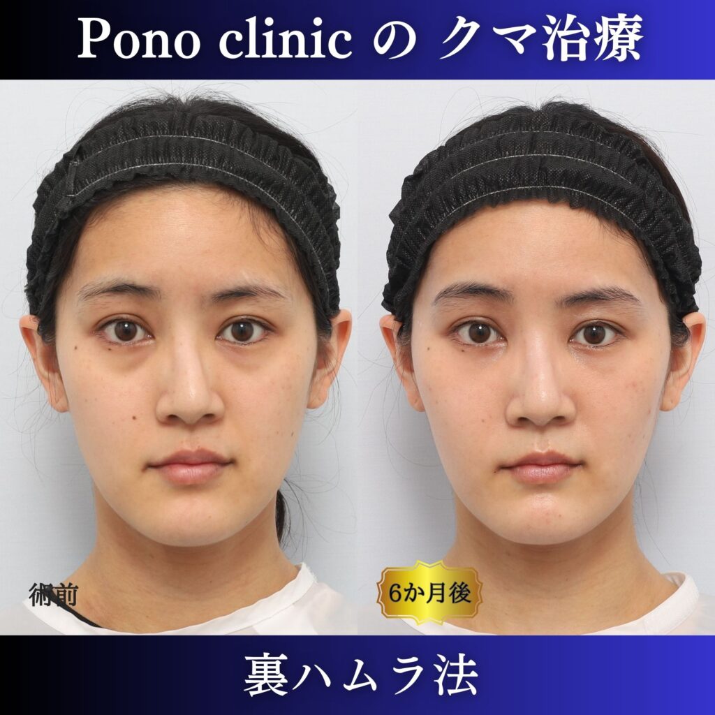 目の下のクマ、裏ハムラ、20代の症例 (7)