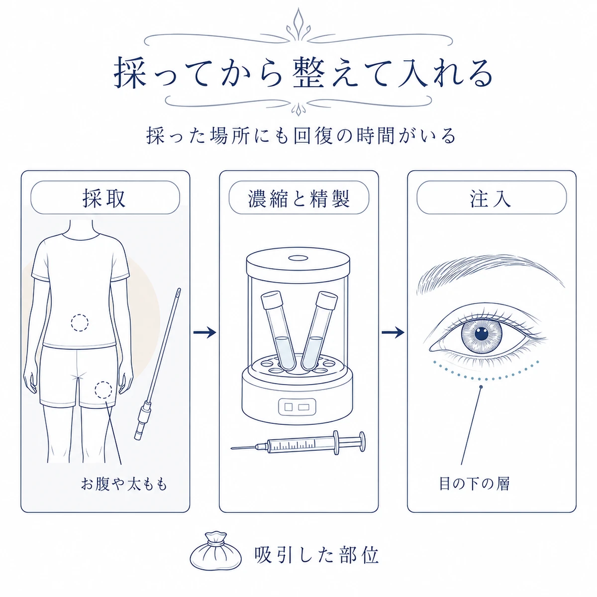 お腹や太ももから採取した脂肪を濃縮・精製し、目元へ注入する3工程の図
