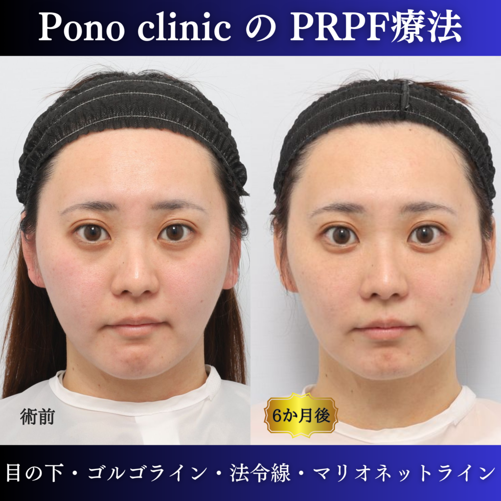 30代女性のPRPF®療法前と治療後6か月を比較した正面の症例写真