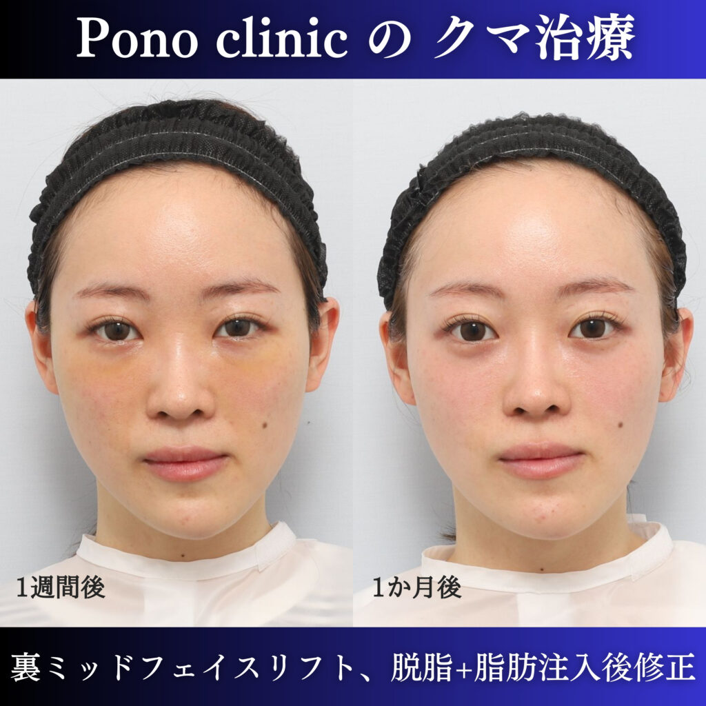 20代女性の裏ミッドフェイスリフト術後1週間と1か月の経過比較