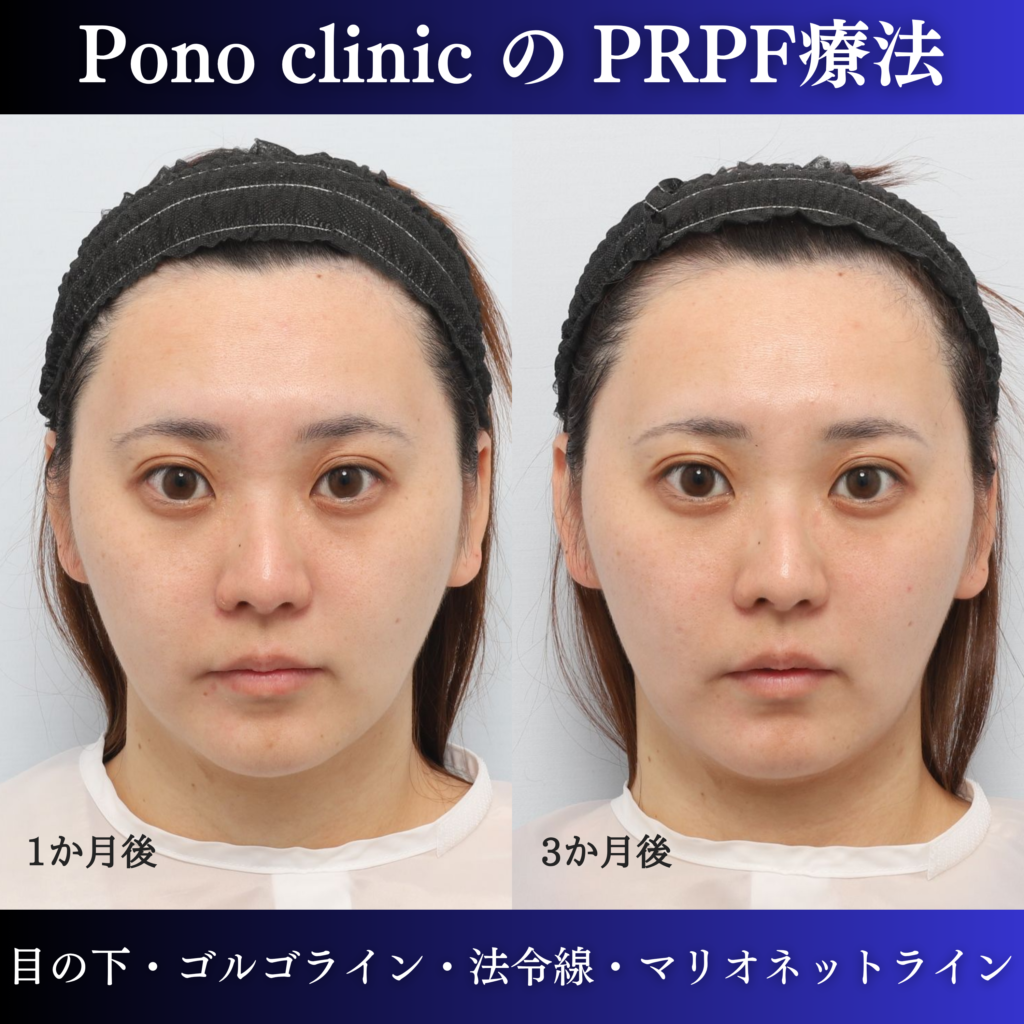 PRPF®療法後1か月と3か月の経過を比較した症例写真