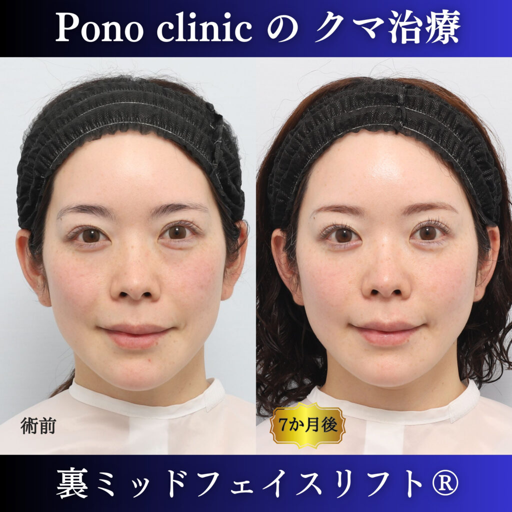 裏ミッドフェイスリフト前と術後6か月の笑顔を比較した症例写真