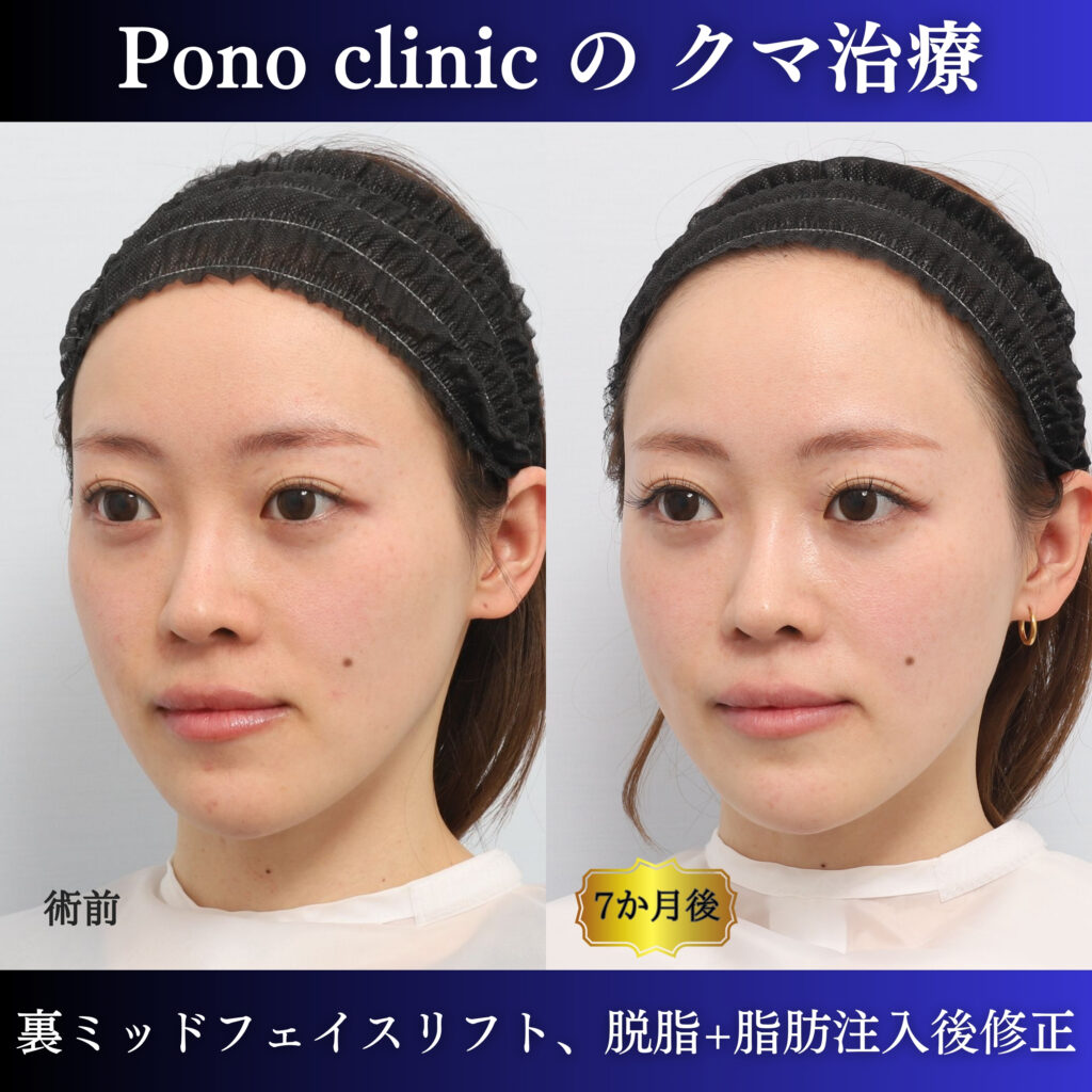 20代女性の裏ミッドフェイスリフト術前・術後6か月の左斜位比較