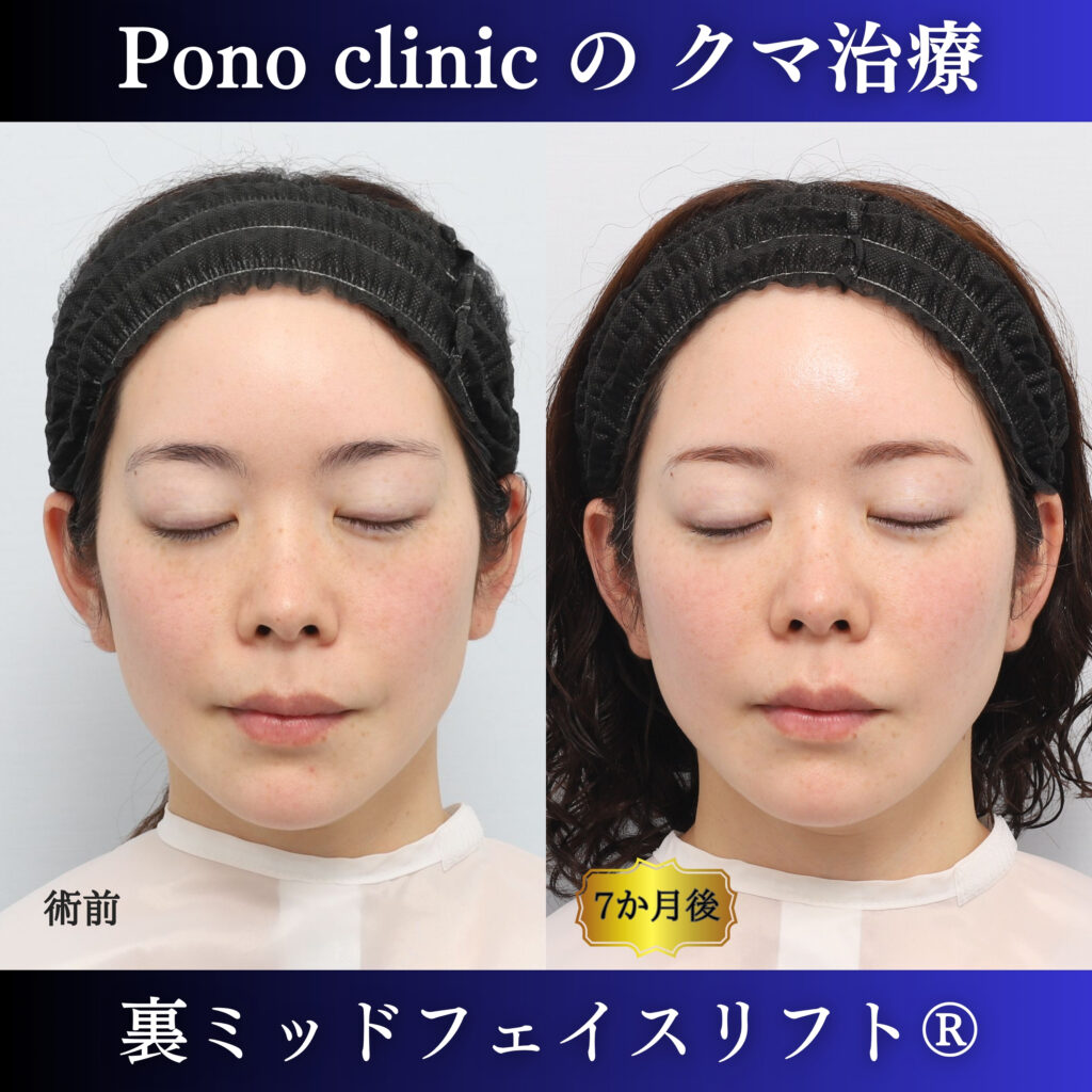 裏ミッドフェイスリフト前と術後6か月を目を閉じた状態で比較した症例写真