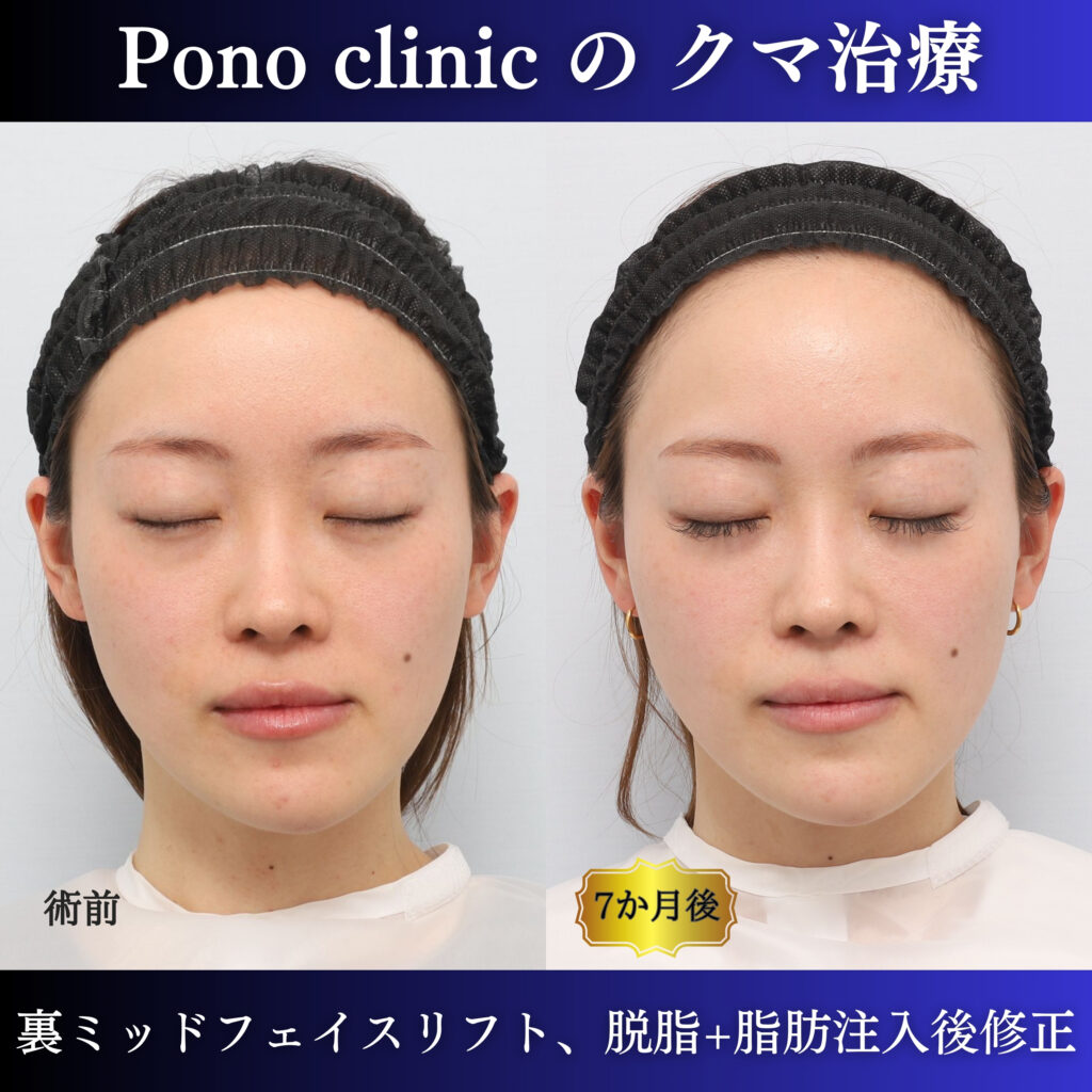 20代女性の裏ミッドフェイスリフト術前・術後6か月の閉眼比較