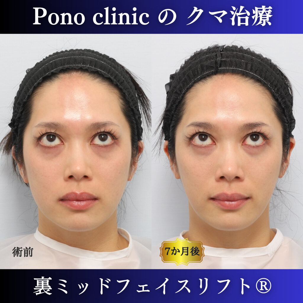 30代女性の裏ミッドフェイスリフト術前・術後7か月の上方視比較