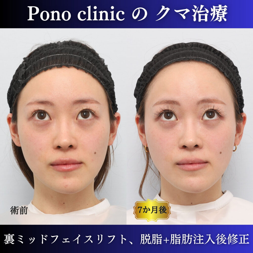20代女性の裏ミッドフェイスリフト術前・術後6か月の上方視比較