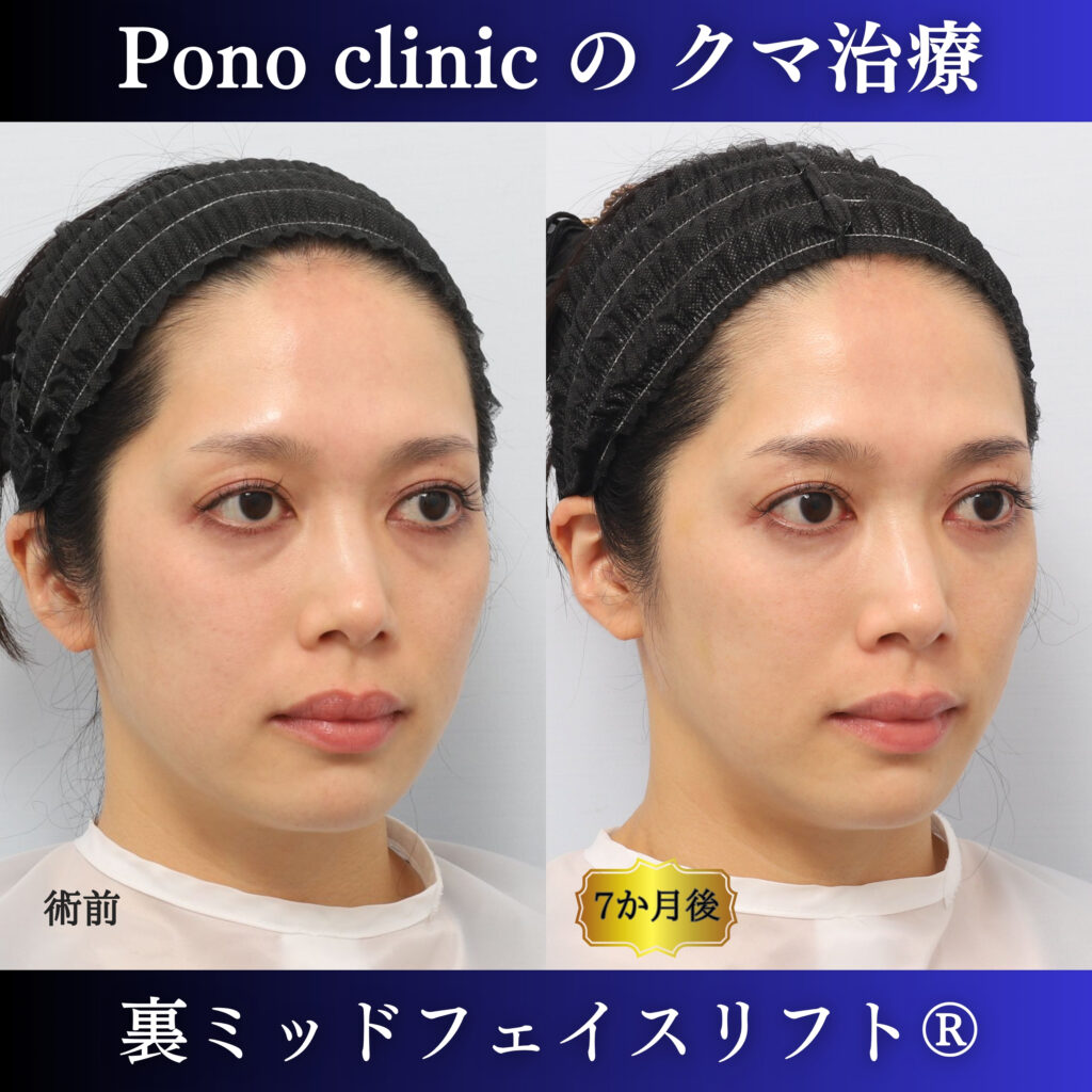 30代女性の裏ミッドフェイスリフト術前・術後7か月の右斜位比較