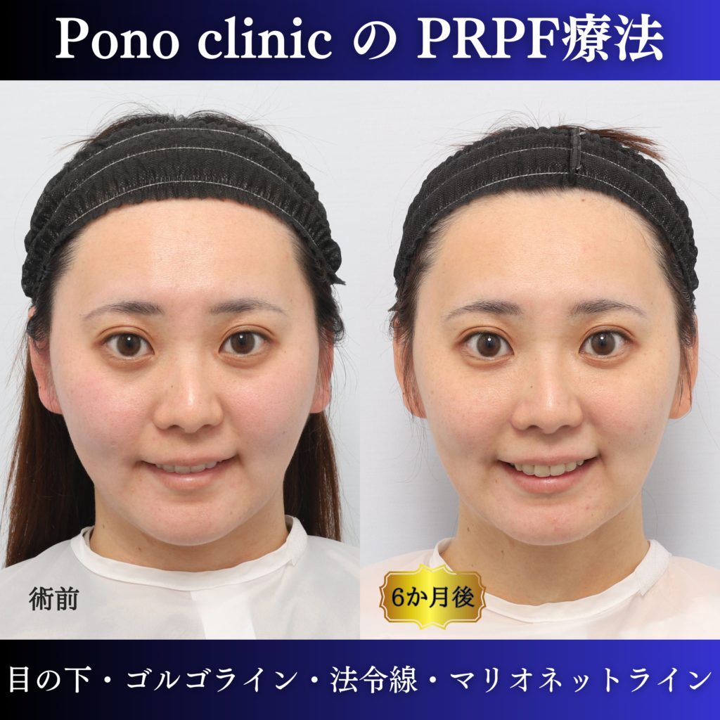 PRPF®療法前と治療後6か月の笑顔を比較した症例写真