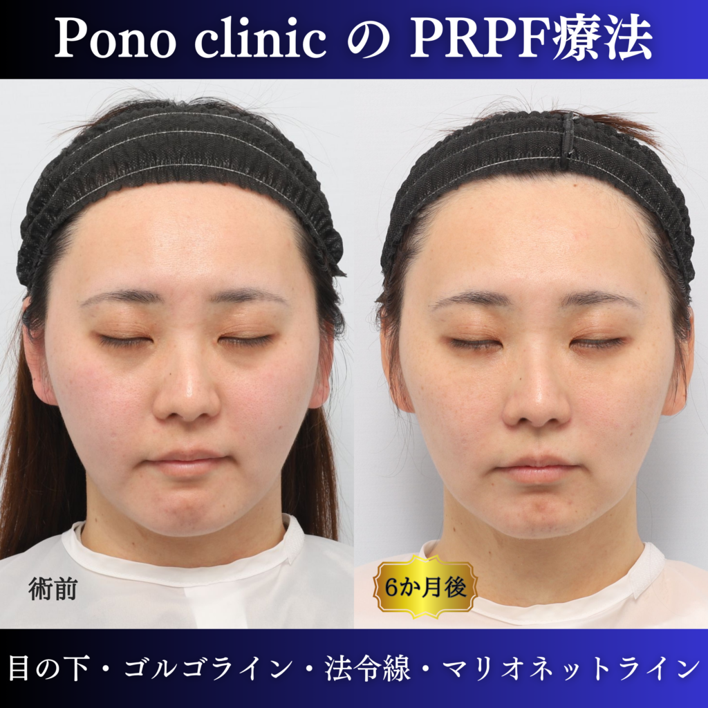 PRPF®療法前と治療後6か月を閉眼した状態で比較した症例写真