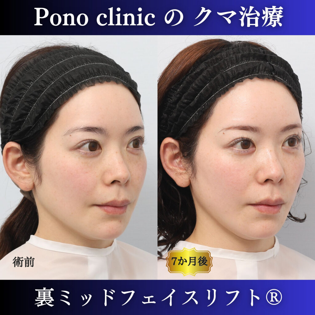 裏ミッドフェイスリフト前と術後6か月を右斜位で比較した症例写真