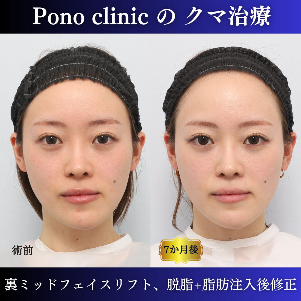 20代女性の裏ミッドフェイスリフト術前・術後6か月の正面比較