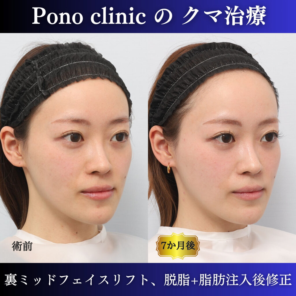 20代女性の裏ミッドフェイスリフト術前・術後6か月の右斜位比較