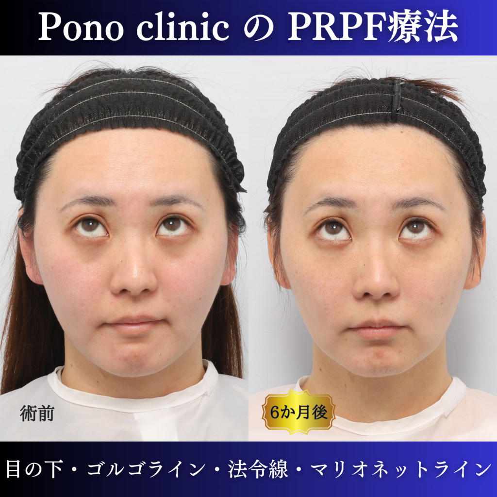 PRPF®療法前と治療後6か月を上方視で比較した症例写真