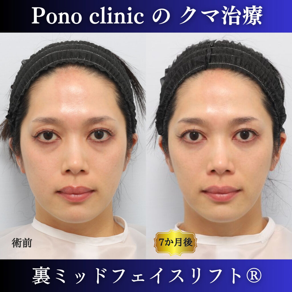 目の下のクマ治療、裏ミッドフェイスリフト、ミッドフェイスリフト、骨膜下リフト、裏ハムラ、30代の症例 (7)