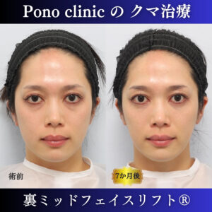 目の下のクマ治療、裏ミッドフェイスリフト、ミッドフェイスリフト、骨膜下リフト、裏ハムラ、30代の症例 (7)