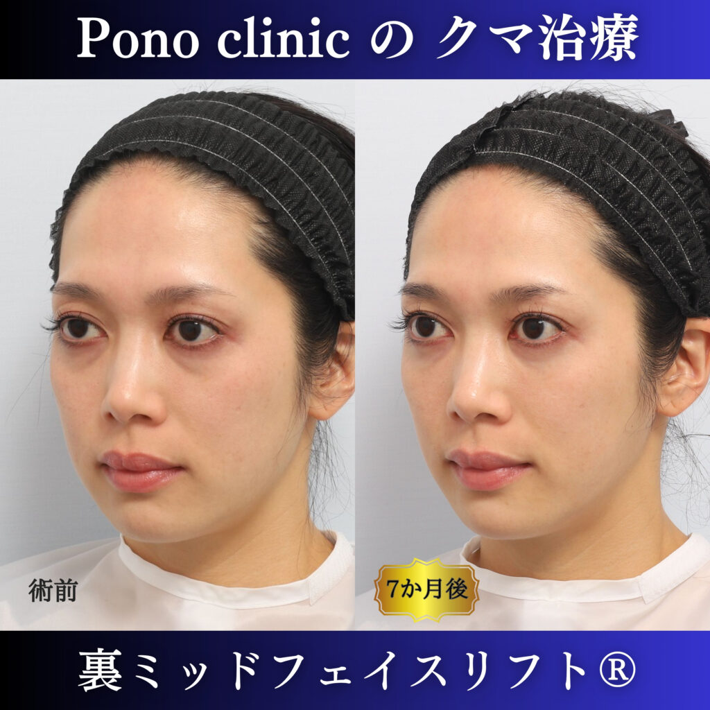 30代女性の裏ミッドフェイスリフト術前・術後7か月の左斜位比較