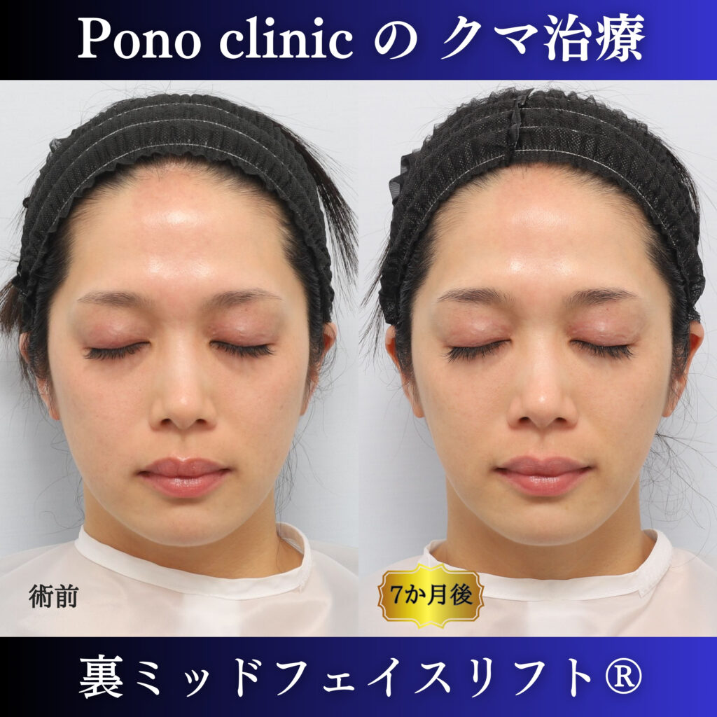 30代女性の裏ミッドフェイスリフト術前・術後7か月の閉眼比較