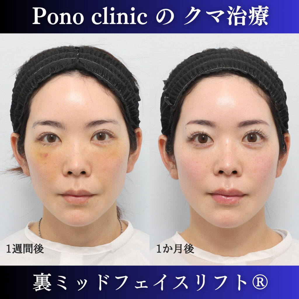 裏ミッドフェイスリフト後1週間と1か月の経過を比較した症例写真