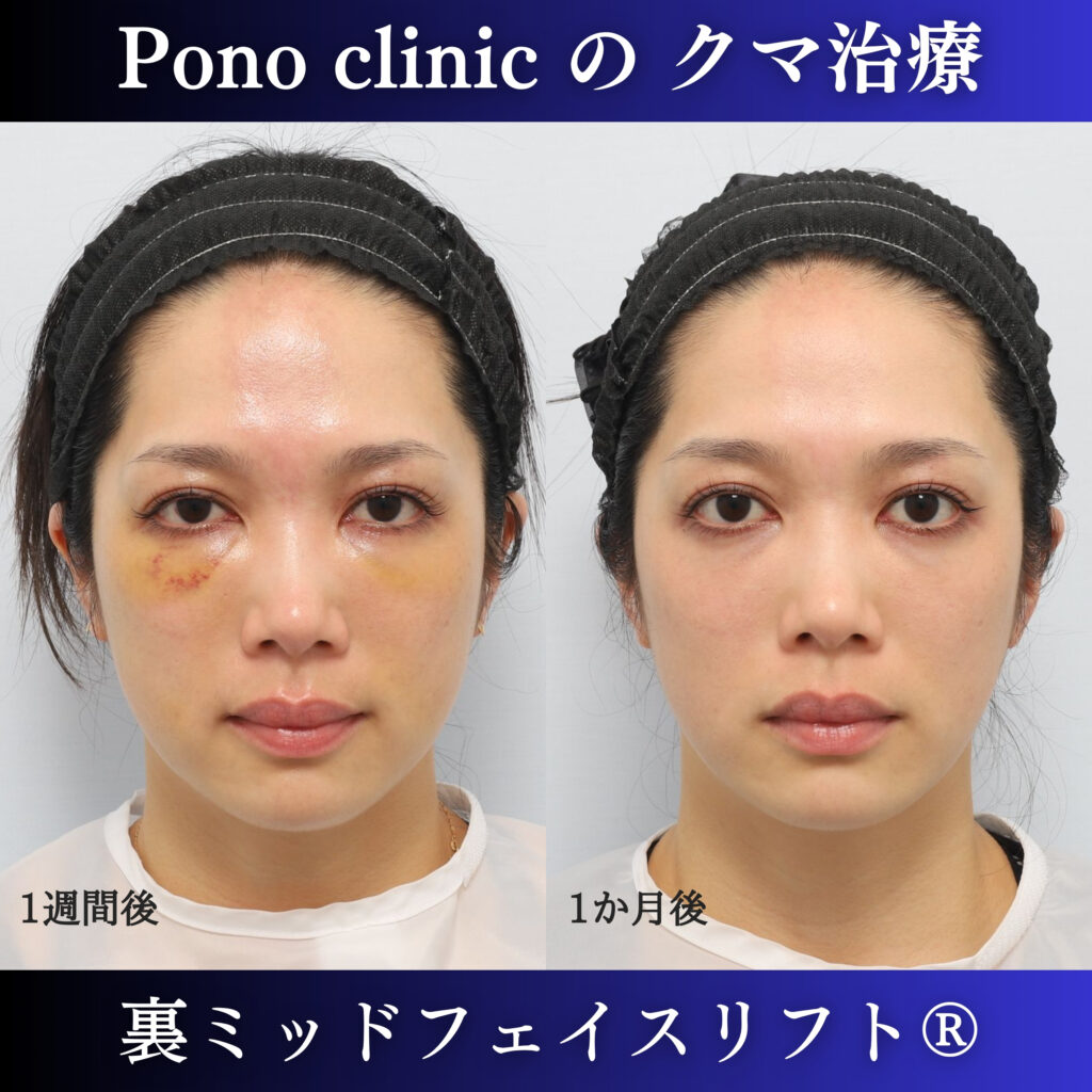 裏ミッドフェイスリフト術後1週間・1か月の経過比較
