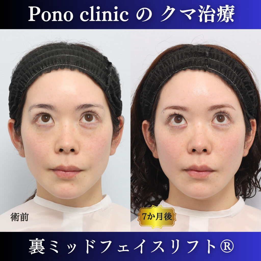 裏ミッドフェイスリフト前と術後6か月を上方視で比較した症例写真