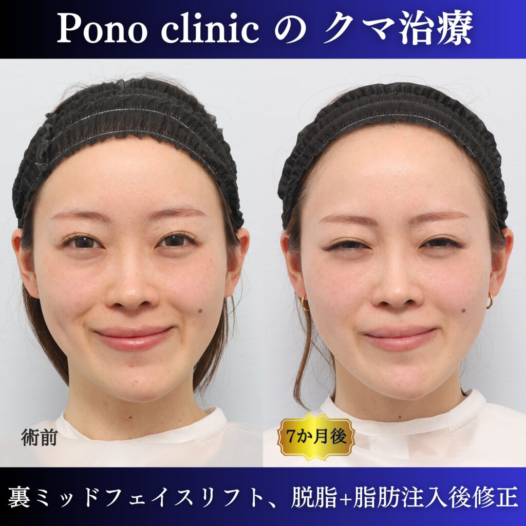 20代女性の裏ミッドフェイスリフト術前・術後6か月の笑顔比較