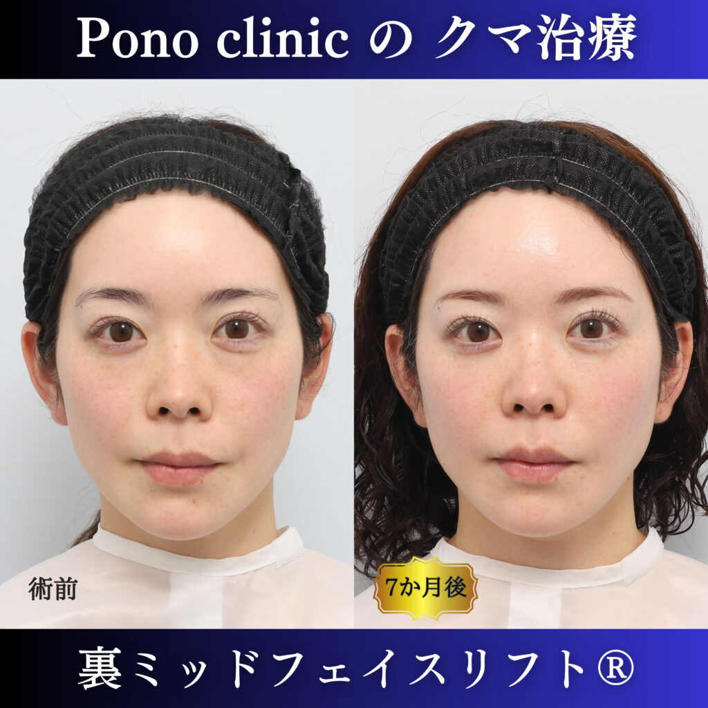 30代女性の裏ミッドフェイスリフト前と術後6か月を比較した正面の症例写真