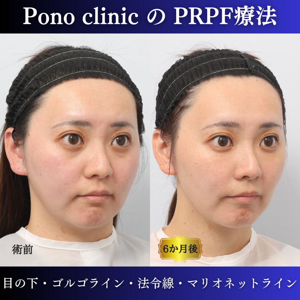 PRPF®療法前と治療後6か月を右斜位で比較した症例写真